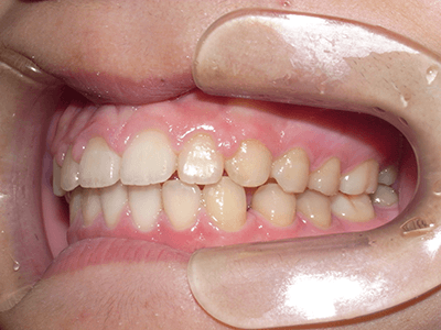 すきっ歯矯正前の左向写真
