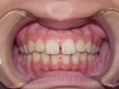 すきっ歯矯正前の正面写真