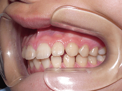 すきっ歯矯正前の左向写真