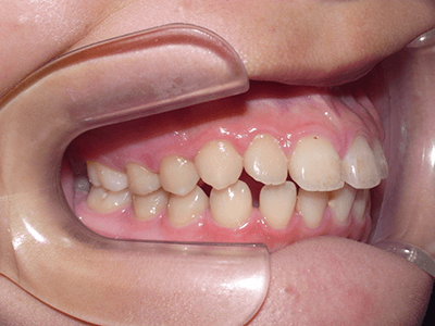 すきっ歯矯正前の右向写真